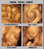 四维彩超单上的数据怎么看？看完就明白