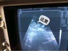 厦门哪家B超医院比较好